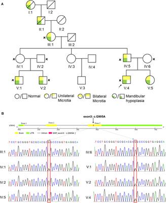 A Mutation in VWA1, Encoding von Willebrand Factor A Domain-Containing Protein 1, Is Associated With Hemifacial Microsomia